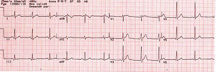 Exemple d'électrocardiogramme